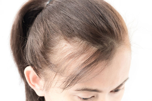 Will PCOS Hair Loss Stop?